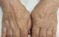 Hand-Rejuvenation-Treatment-1_before.jpg