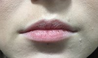 lip-enhancement-3_before.jpg