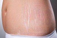 stretch-marks-treatment-droitwich.jpg