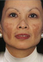 Melasma.jpg