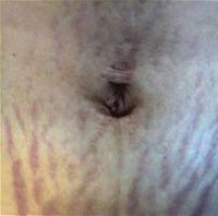 Stretch-Marks-1_before.jpg