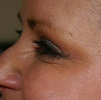 botox-treatments-1_after.jpg