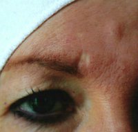 dermapen_1_before.jpg