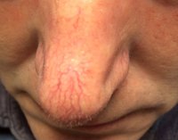 laser-thread-vein-removal_2_before.jpg