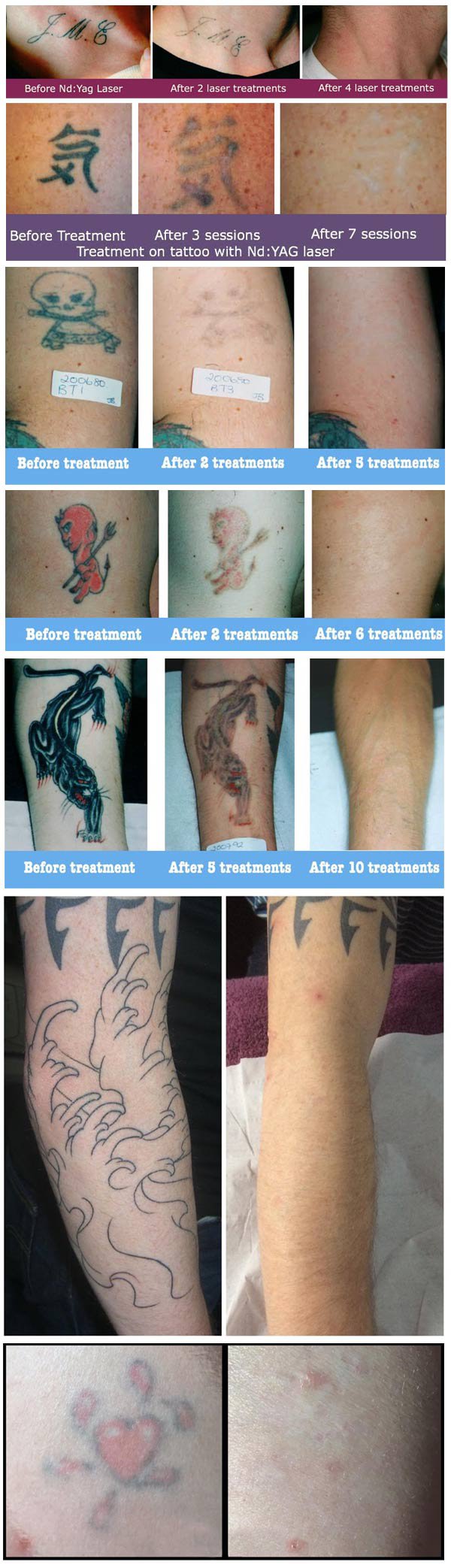 Tattoo Removal Treatments at Cheshire Lasers Clinic in Middlewich