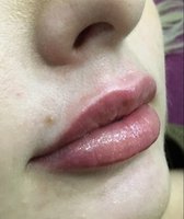 lip-enhancement-1_after.jpg