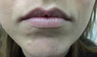 lip-enhancement-5_before.jpg