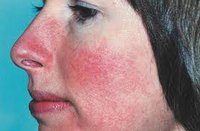 rosacea-1.jpg