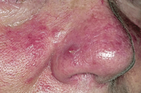 rosacea-2.jpg.gif